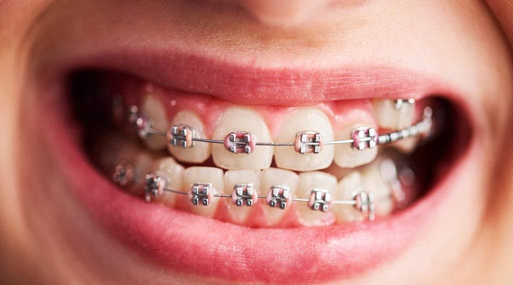 ¿Cuánto dura el tratamiento de ortodoncia?