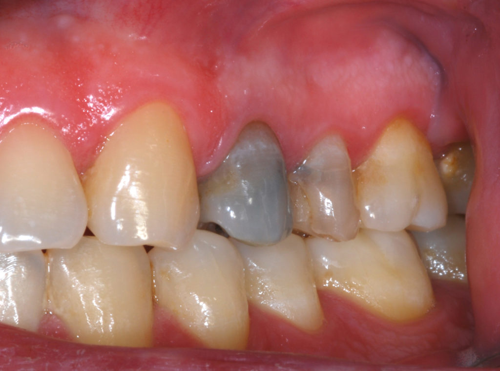 enfermedad diente negro