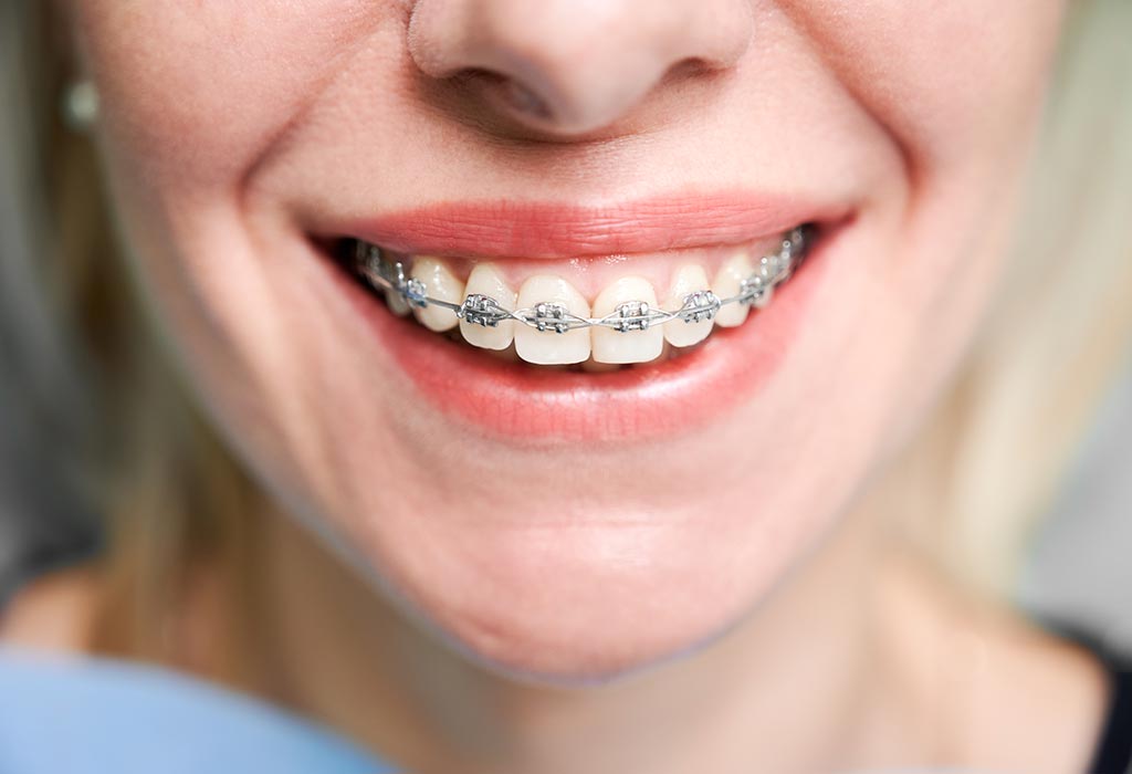 ¿Cuánto dura el tratamiento de ortodoncia?